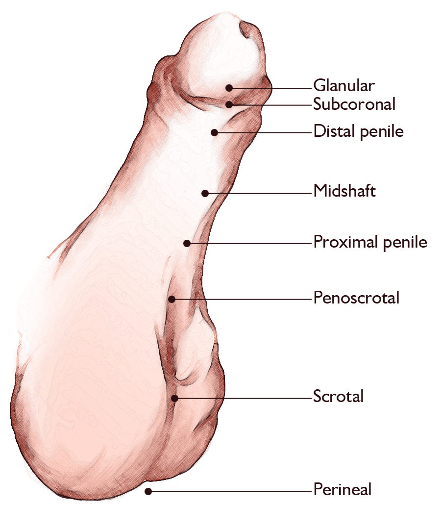 Hypospadias diagram