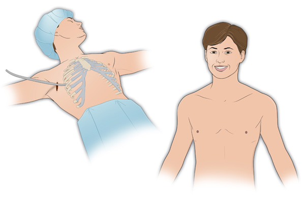 Description of the final phase of the Pectus Surgery