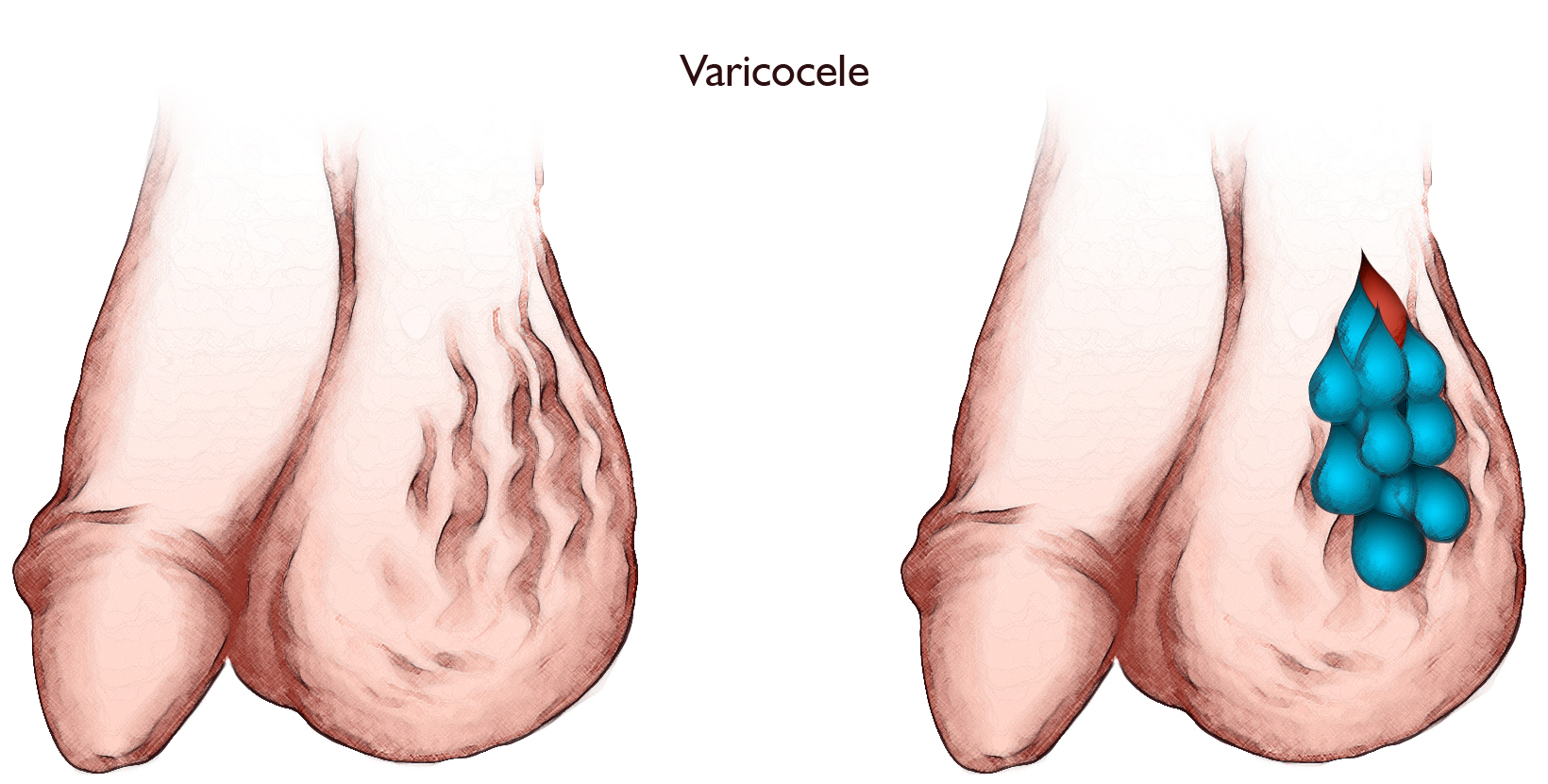 Varicocele rendering