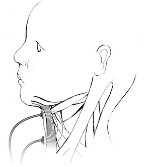 Diagram of Neuromuscular electrical stimulation therapy