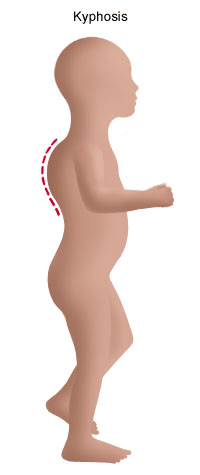Kyphosis Treatment - Children's Health Orange County