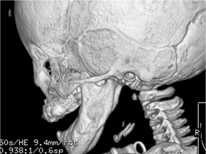X-ray of baby's jaw after distraction