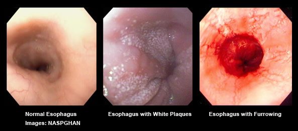 General Information About Eosinophilic Esophagitis