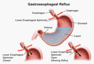 Acid reflux and throat infection
