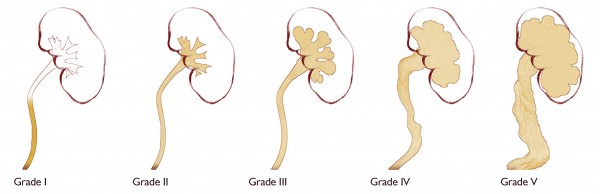 vesicoureteral reflux