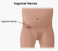 Inguinal hernia