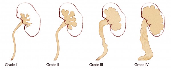 hydronephrosis