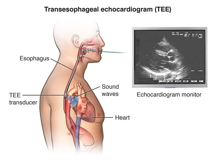 Transesophageal Echocardiograms