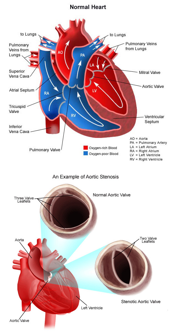 Aortic Valve Stenosis: Symptoms- Causes And Treatments