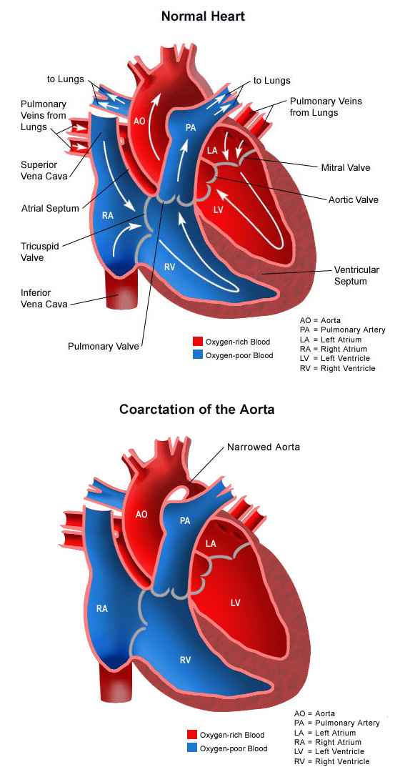 Coarctation Of The Aorta Choc Children S