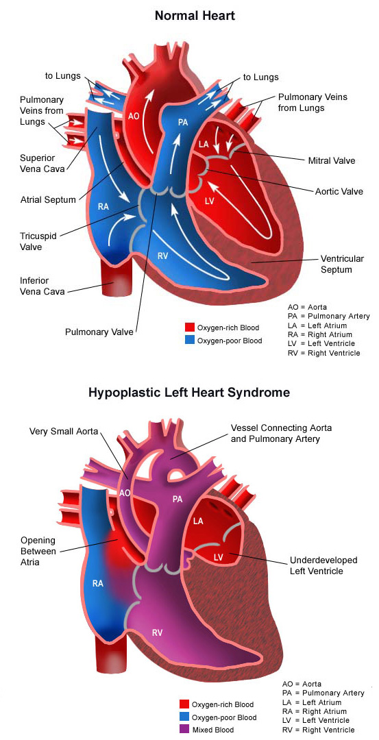 Hypoplastic Left Heart Syndrome CHOC Children's