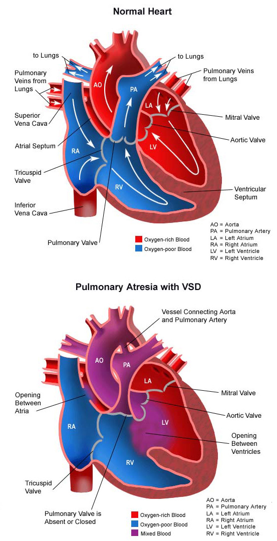 Pulmonary Atresia