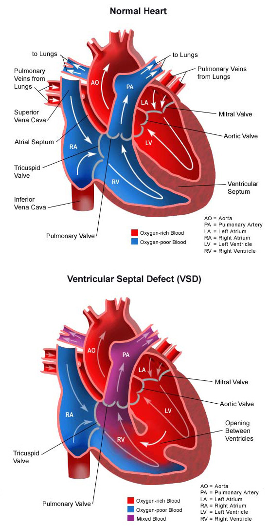 ventrikulär Septal defekt vertikal