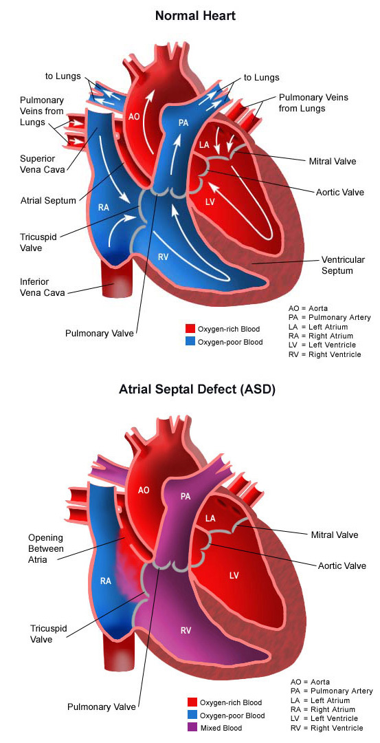 Pathophysiology Of Atrial Septal Defect In Flow Chart