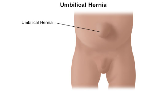 Umbilical Hernia Repair: What to Expect at Home