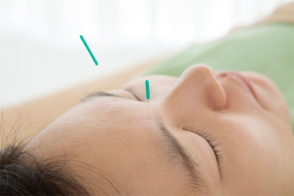 young girl, acupuncture needles