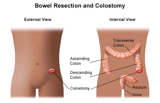 Bowel Resection and Colostomy