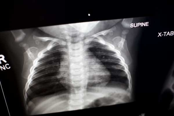Child chest x-ray