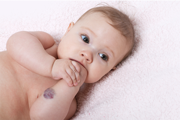 baby with hemangioma