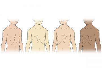 Pectus Excavatum - sunken chest