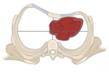 Pectus Excavatum - sunken chest
