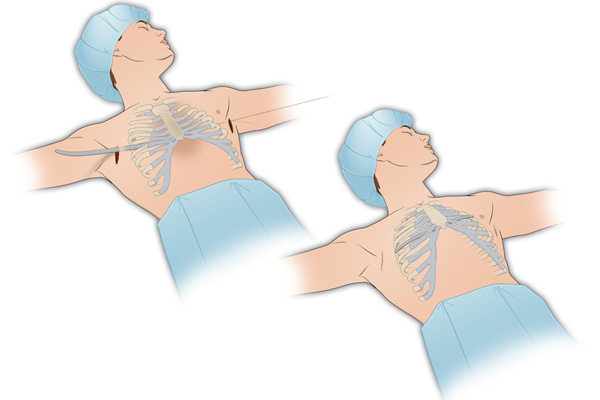 Image describing the 2 small minimally invasive incisions of a patient undergoing the Nuss Procedure