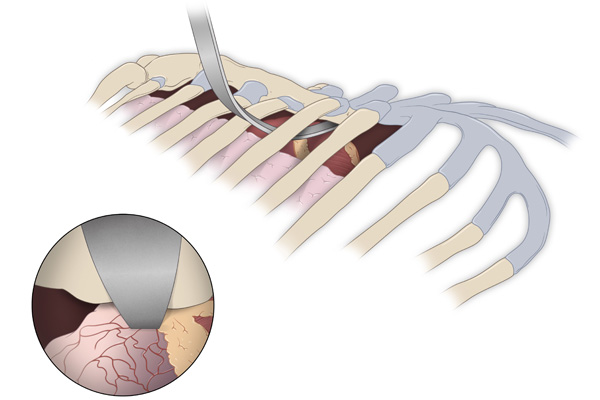 Image of how the Nuss Procedure works when going inside the rib cage