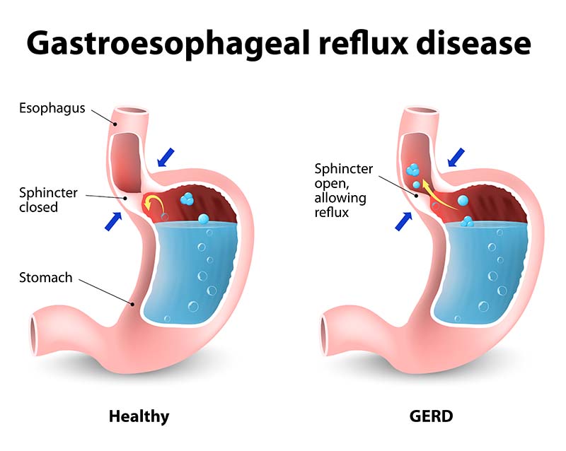 This diagram shows the abnormal flow of gastric acid from the stomach into the esophagus. This is how gastroesophageal reflux (GER) or heartburn occurs in kids.
