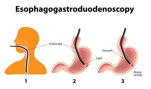 Diagram showing an endoscope's path through the body during an upper endoscopy, from the mouth to the stomach