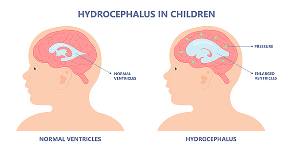 Diagram showing a normal brain and a brain with hydrocephalus