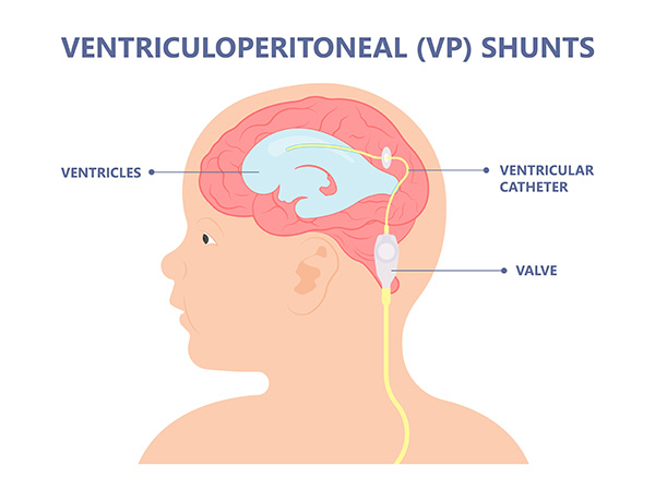 Diagram showing the parts of a hydrocephalus shunt, including the shunt, the tube and the valve