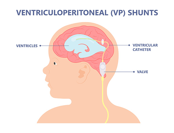 Ventriculoperitoneal Shunt Placement for Hydrocephalus in Adults - What You  Need to Know