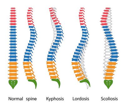 Diagram showing different types of spinal deformities