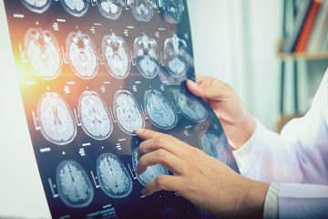 doctor pointing to brain scans