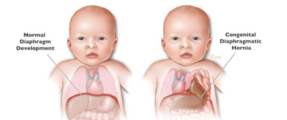 A child's normal diaphragm versus CDH