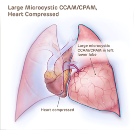 Large microcystic CCAM/CPAM where heart is compressed