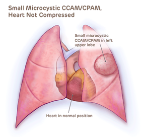 Small Microcystic CCAM/CPAM where Heart is not Compressed
